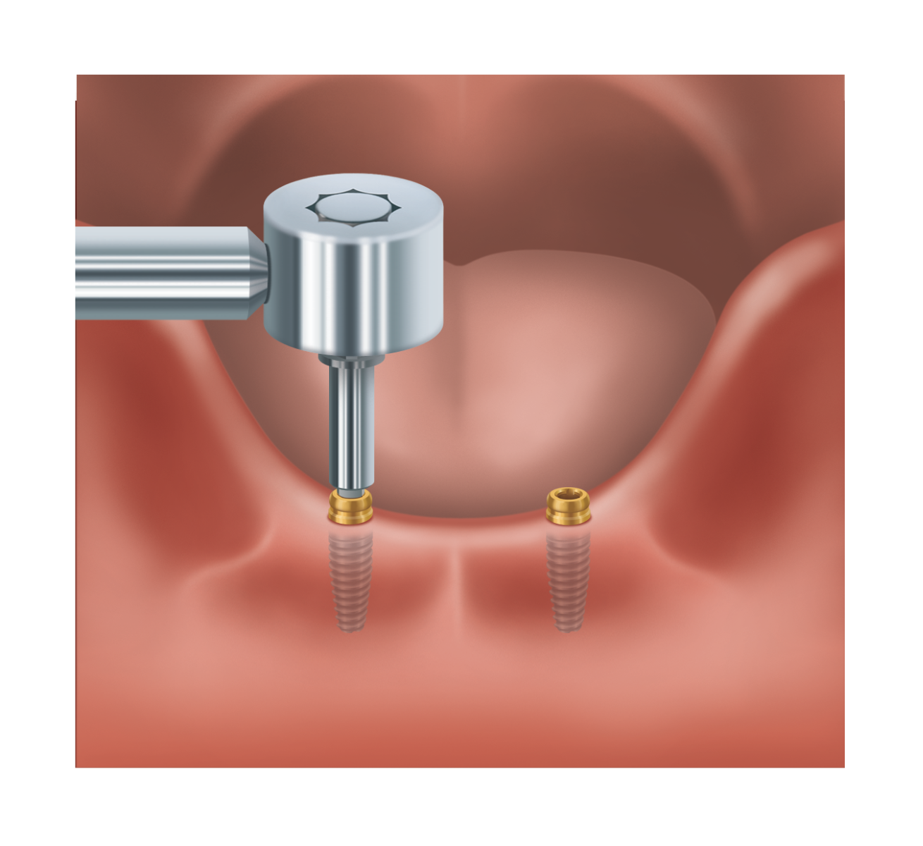 Torque LOCATOR abutment
